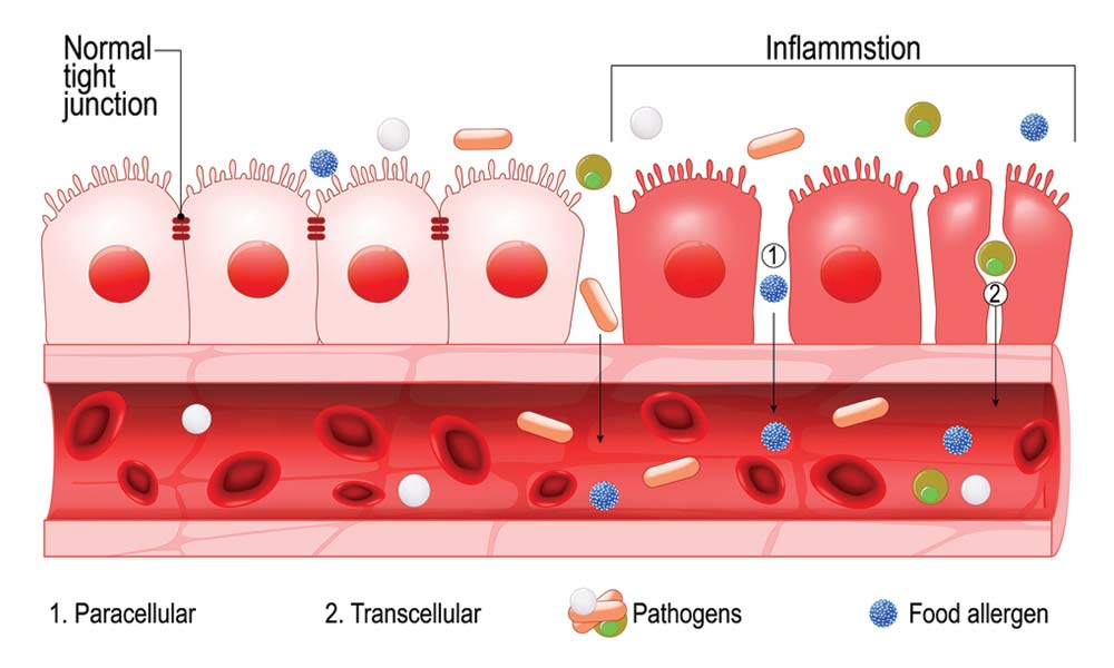 diagram-showing-leaky-gut